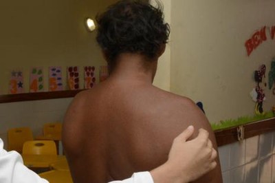 Saúde lembra que hanseníase tem cura e tratamento gratuito na rede pública municipal