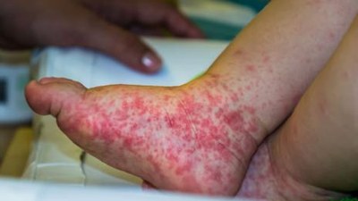 Vigilância Epidemiológica alerta para surto da doença mão pé boca em Araguaína