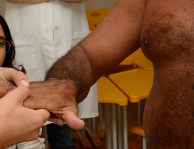 Hanseníase: a partir do dia 21, Carreta Roda Hans oferece uma oportunidade gratuita e ágil de diagnóstico da doença em Araguaína